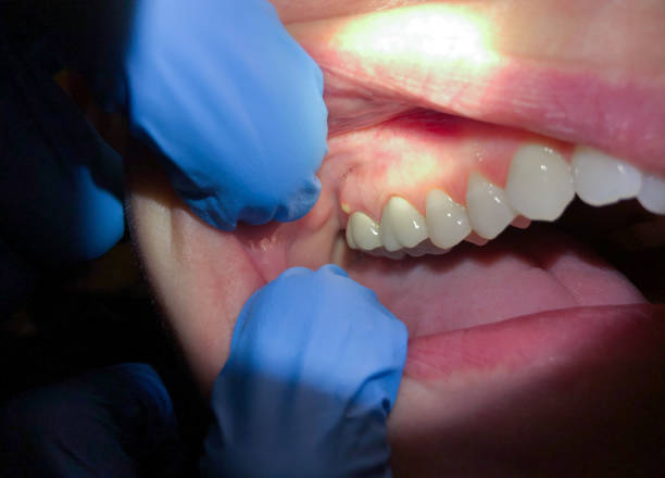 Best Emergency Dental Care for Broken or Chipped Teeth in Smithers, WV