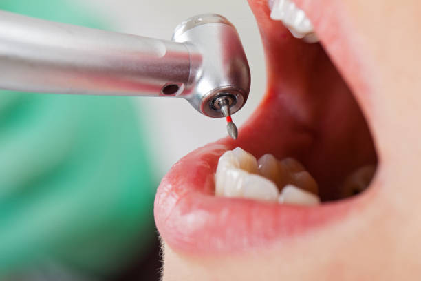 Best Emergency Wisdom Teeth Removal in Smithers, WV